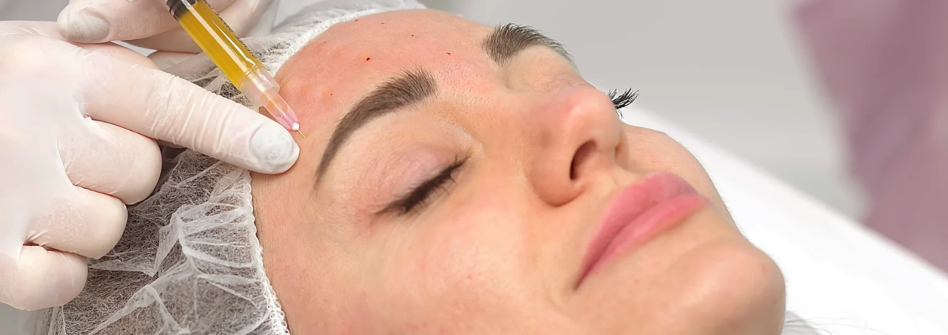 PRP_facial PRP_facial